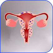 Adenomyosis