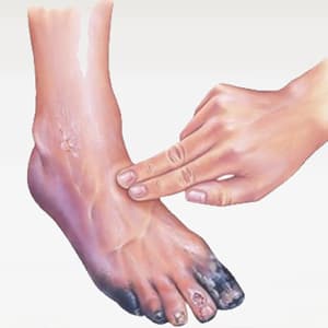 Peripheral Artery Disease