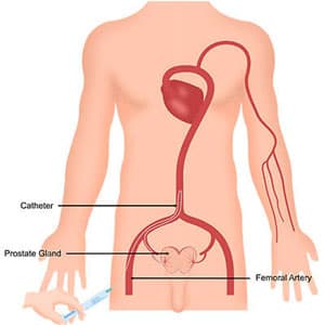 Prostatic Artery Embolization