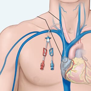 Interventional Oncology