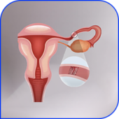 Fallopian tube embolization