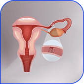 Fallopian tube embolization
