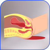 Postpartum
hemorrhage