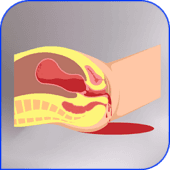 Postpartum
hemorrhage