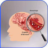 Tumor-related
hemorrhage