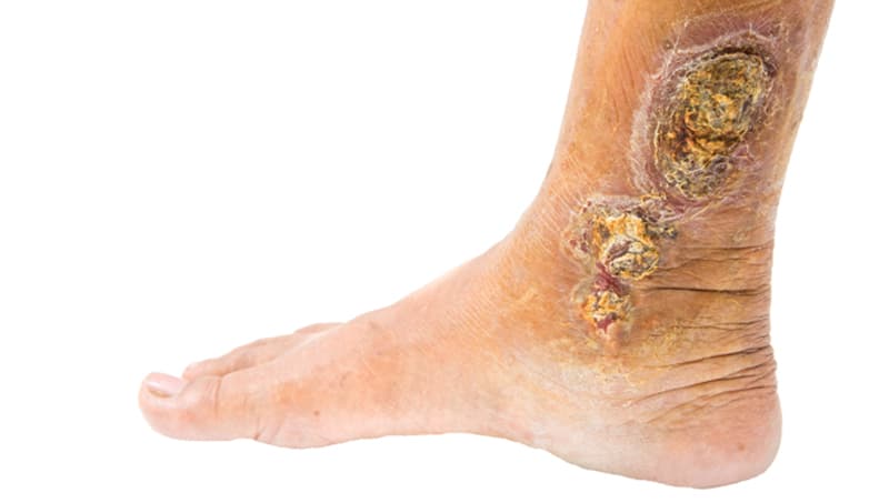 Am I in Danger if I don't Treat My Varicose Veins?